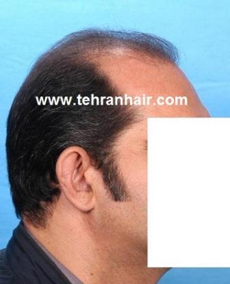 can keratin regrow hair